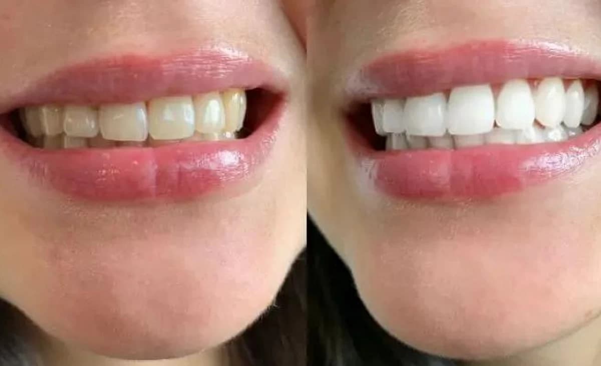 Blanchiment des dents à la maison : avant/après